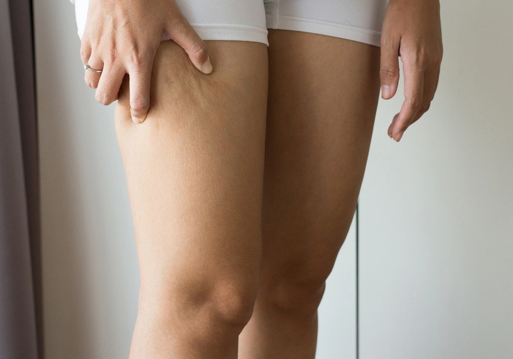 celulitis tratamiento corporal clinca teran