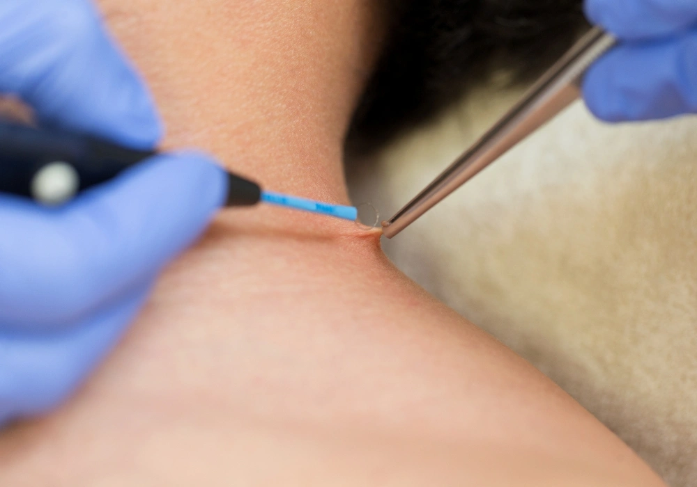 eliminacion verrugas tratamiento aparatologia clinca teran