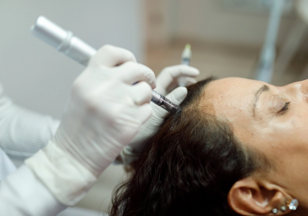 microneedling tratamiento capilar clinca teran microneedling tratamiento capilar clinca teran